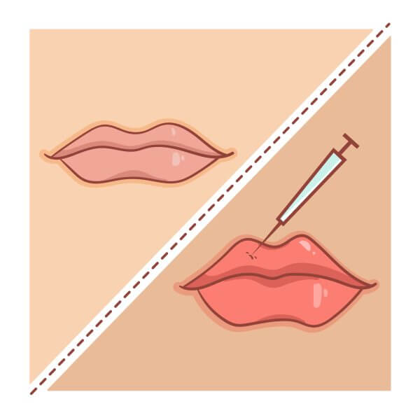 preenchimento labios (3)